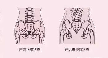 產后修復培訓學校淺談妊娠紋怎么恢復